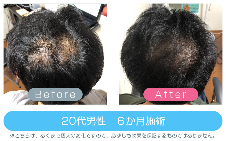 発毛ビフォーアフター