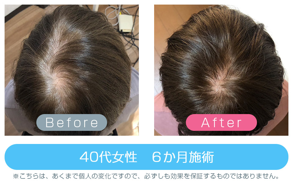 発毛ビフォーアフター