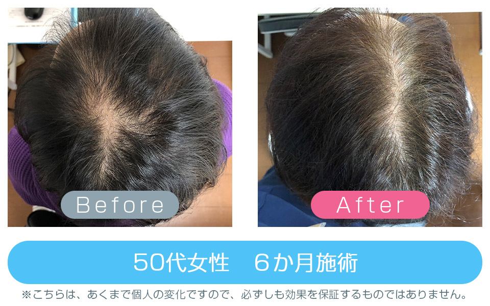 発毛ビフォーアフター