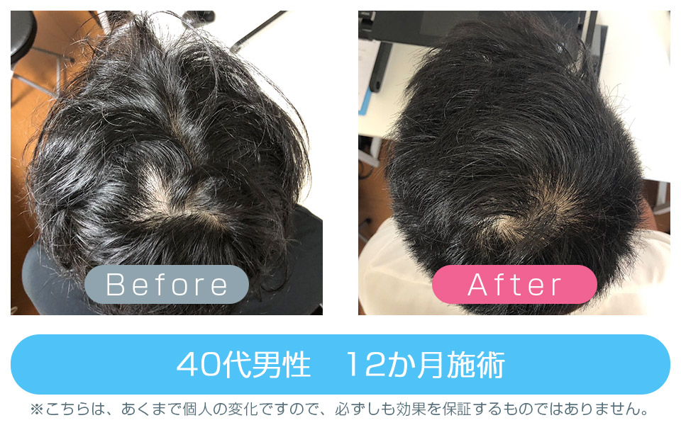 発毛ビフォーアフター
