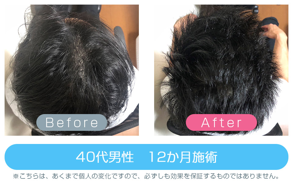 発毛ビフォーアフター
